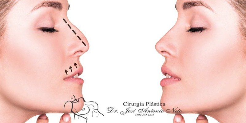 Rinoplastia: cirurgia plástica remodela e diminui o tamanho do nariz